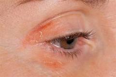 Eczema Face Treatment